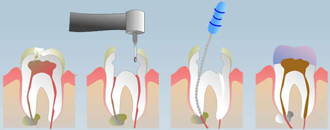 Endodonti Kanal Tedavisi