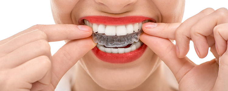 Orthodontic Treatment